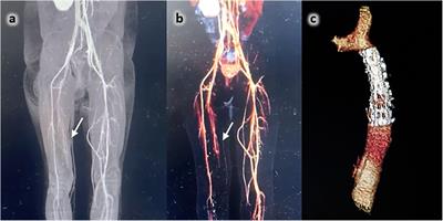 Case Report: Catastrophic antiphospholipid syndrome in a pediatric patient after percutaneous treatment of aortic re-coarctation